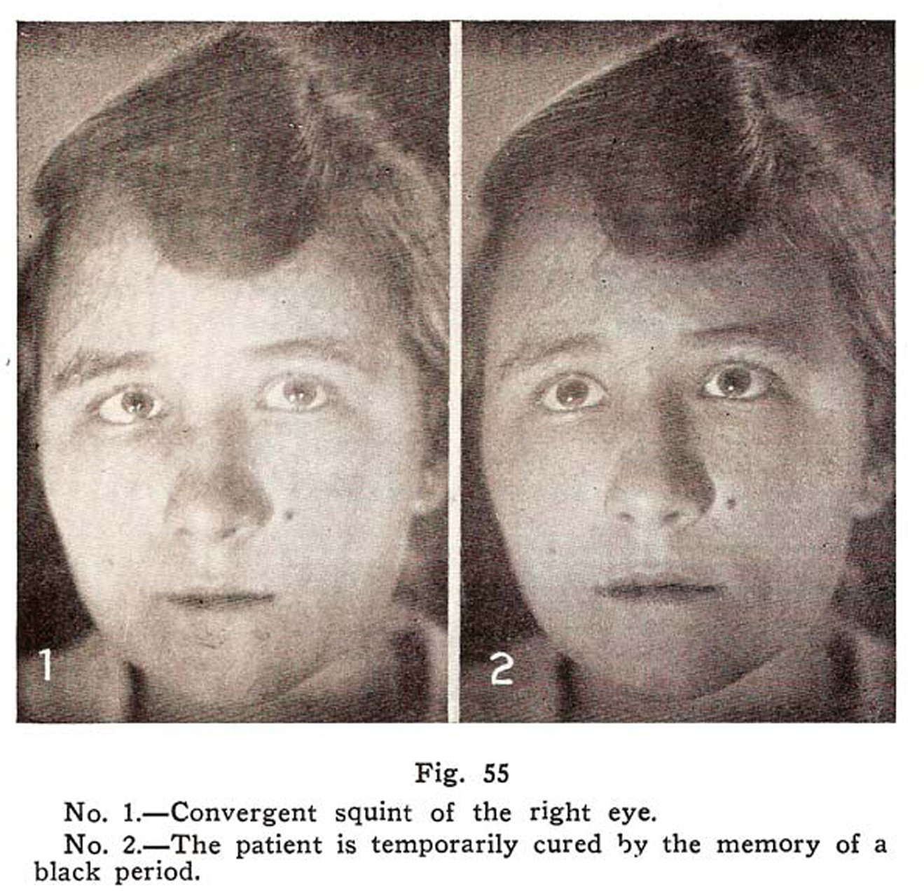 Crossed Eye Condition Cured by Natural Method